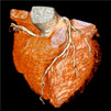 心臓と冠動脈の3次元再構成像