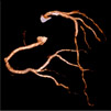 左右のCT冠動脈造影像