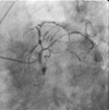 狭心症の冠動脈造影像1