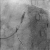 狭心症の冠動脈造影像2