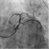 狭心症の冠動脈造影像3