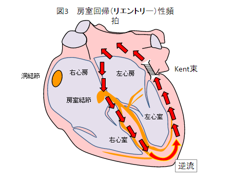 発作性上室性頻拍症の治療薬