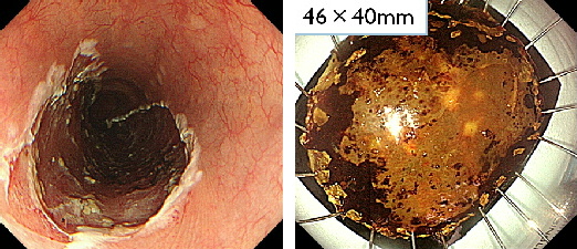 食道ESD３