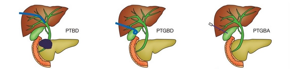 経皮的胆道ドレナージ