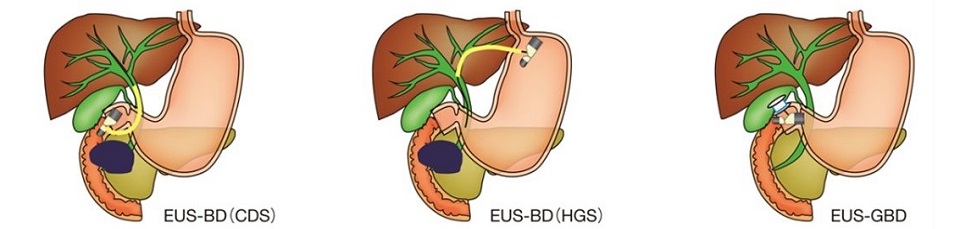 経胃的胆道ドレナージ