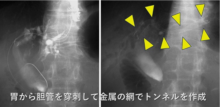 経胃的胆道ドレナージ