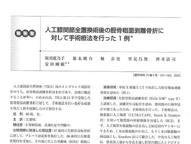 「人工膝関節全置換術後の脛骨粗面剥離骨折に対して手術療法を行った1例」の記事