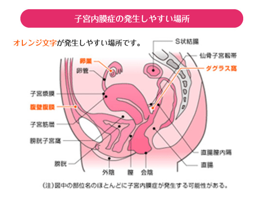 子宮内膜症の発生しやすい場所