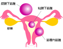 子宮筋腫イメージ